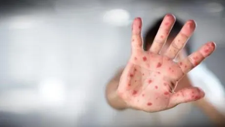 Organizația Mondială a Sănătății intervine pentru prevenirea rujeolei în Caraș-Severin
