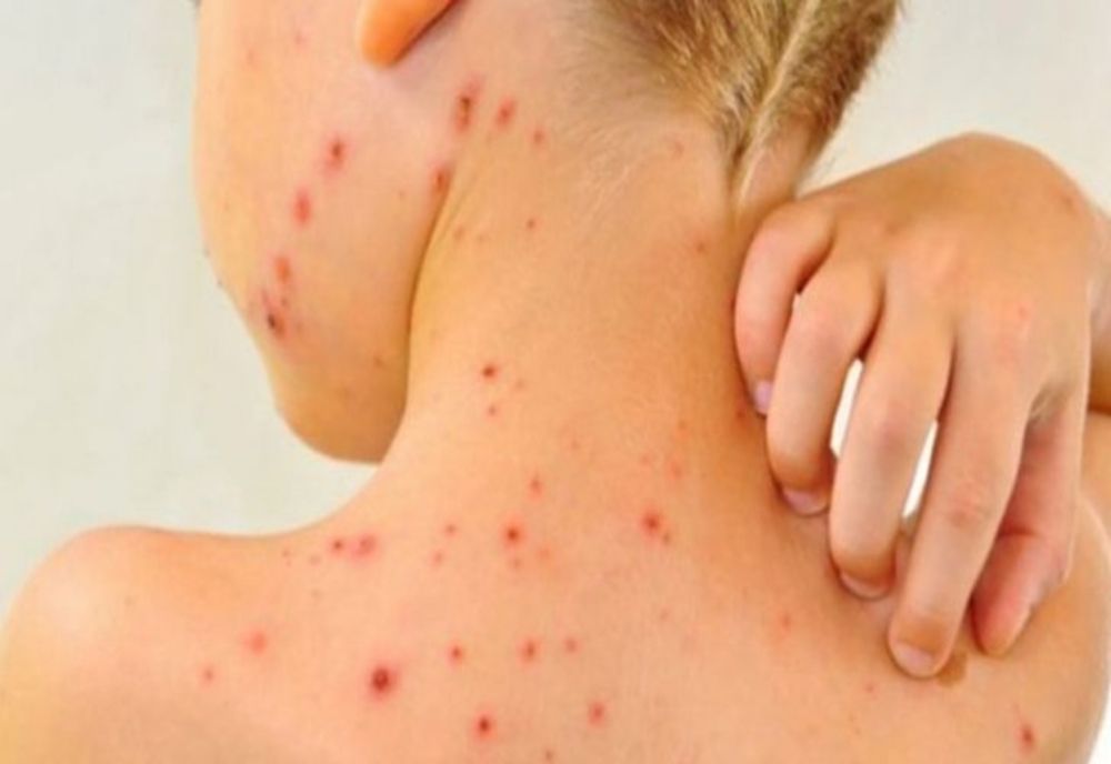 Cinci noi cazuri de rujeolă în județul Dolj 