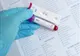 Reșița: Campanie de testare gratuită pentru depistarea virusului hepatic 